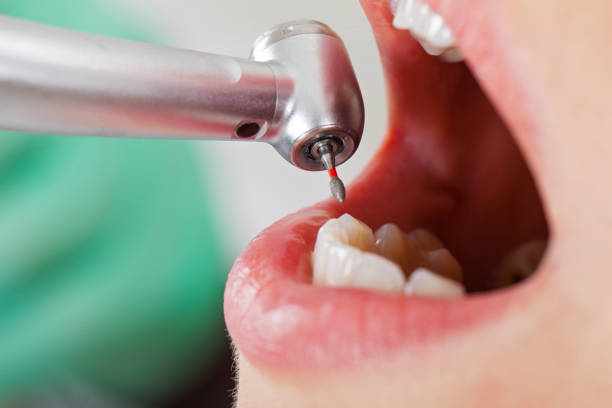 Best Emergency Dentist for Knocked-Out Tooth in West Ocean City, MD